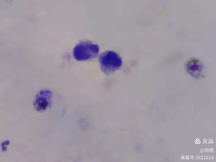 三种疟原虫厚膜染色法对比